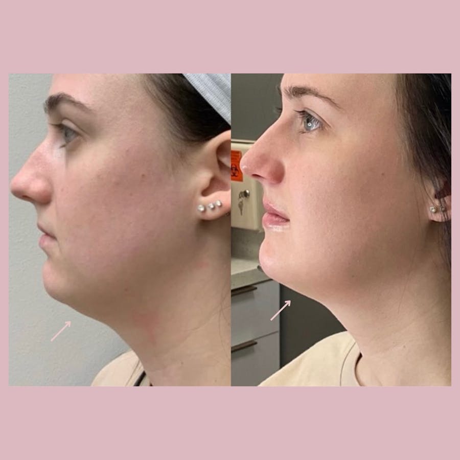 Kybella Before & After - Image 1