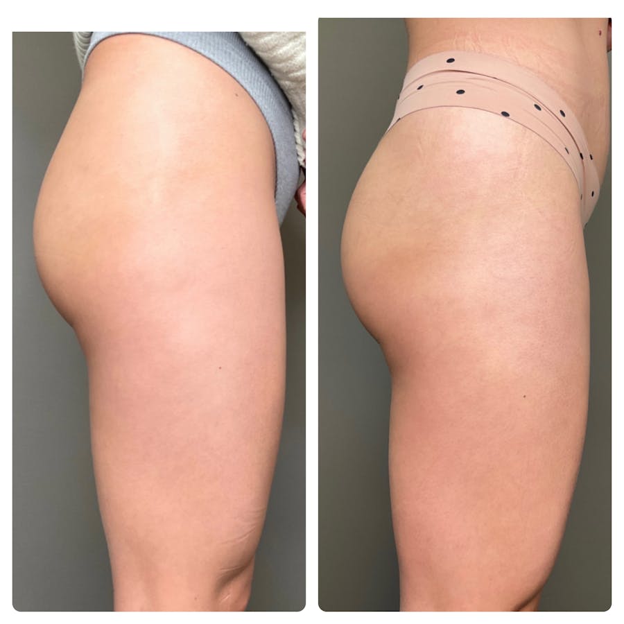 Nonsurgical BBL Before & After - Image 2