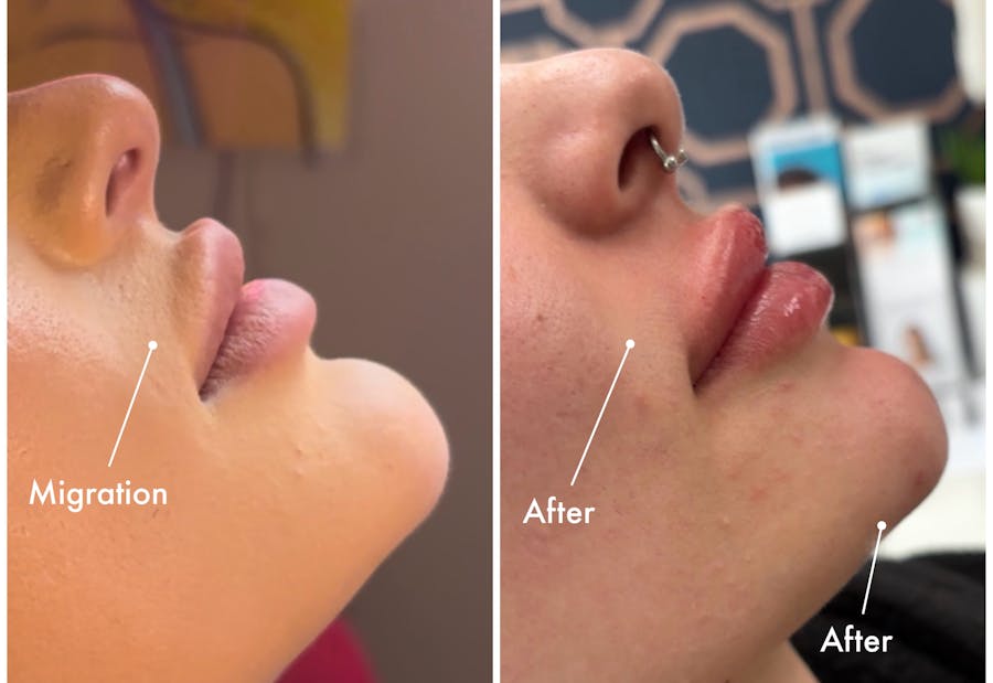 Dissolving Filler Before & After