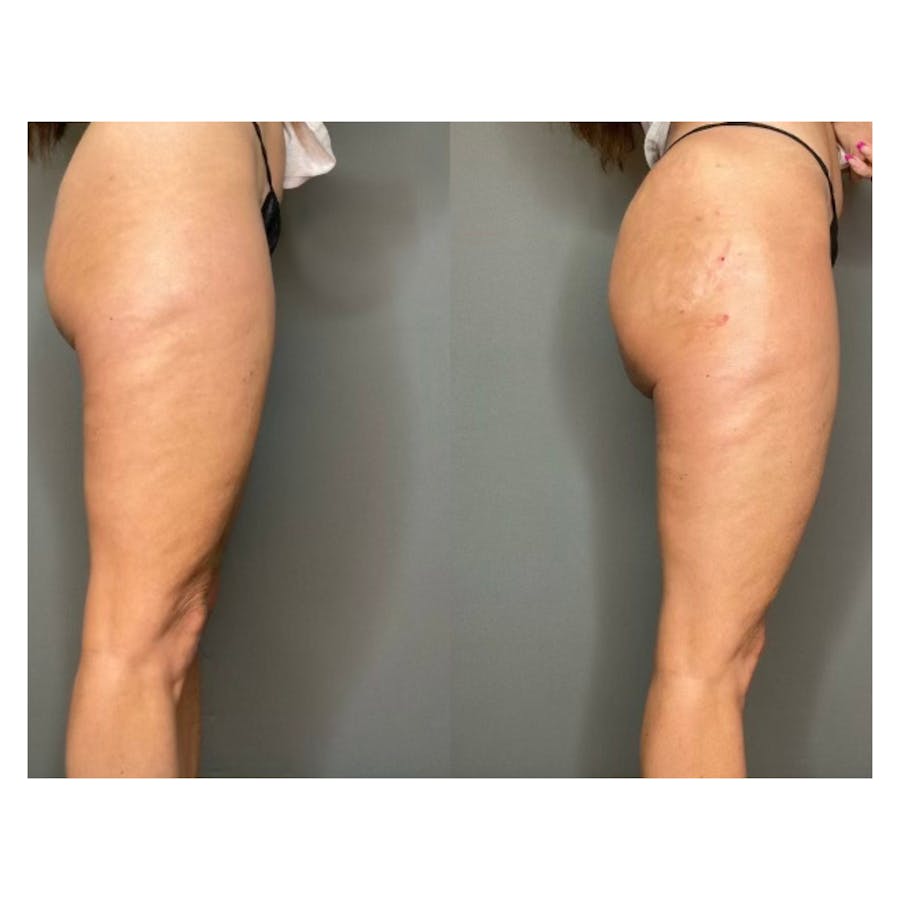 Nonsurgical BBL Before & After - Image 1