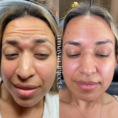 Botox Before & After Gallery - Patient 246933 - Image 1