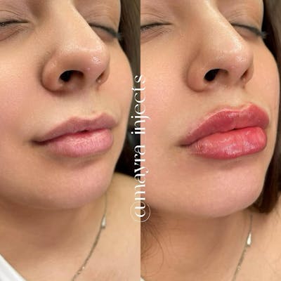 Lip Filler Before & After Gallery - Patient 360790 - Image 1