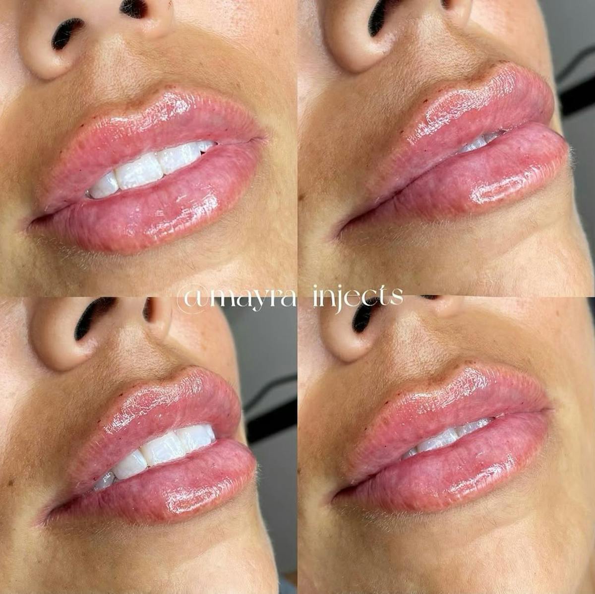 Lip Filler Before & After Gallery - Patient 391501 - Image 1