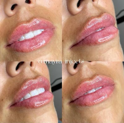 Lip Filler Before & After Gallery - Patient 391501 - Image 1