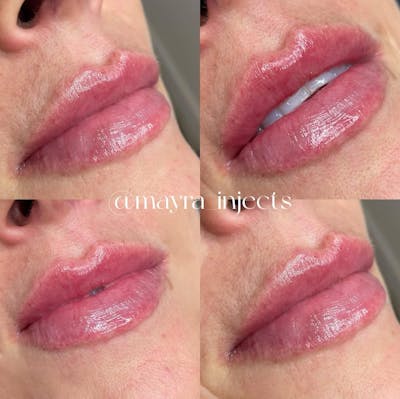 Lip Filler Before & After Gallery - Patient 251732 - Image 1