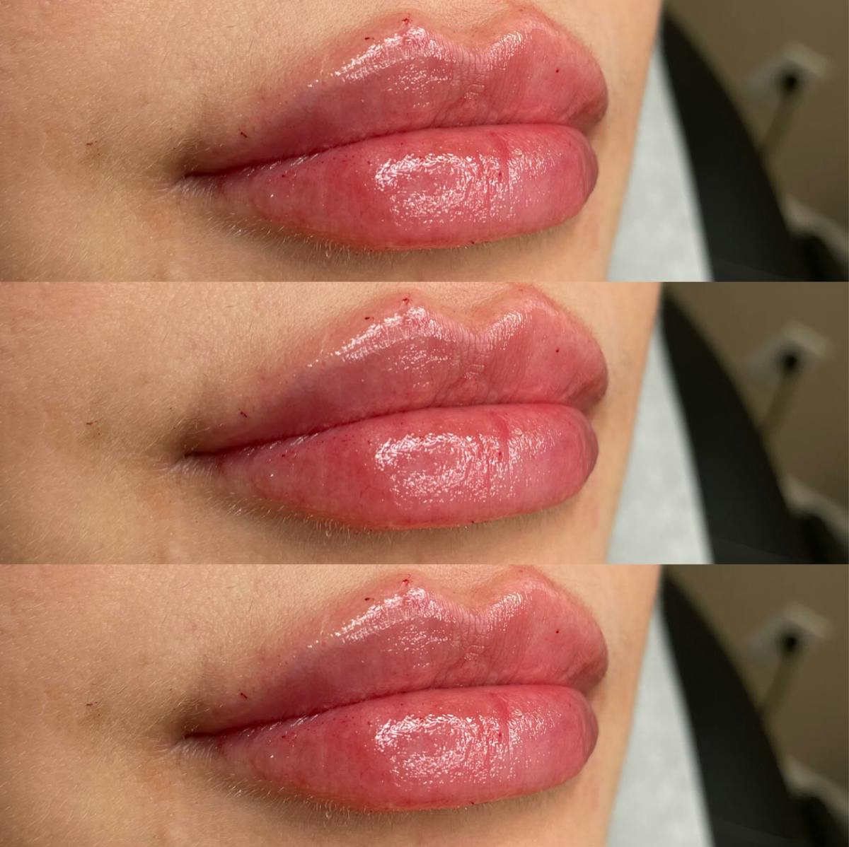 Lip Filler Before & After Gallery - Patient 319433 - Image 1
