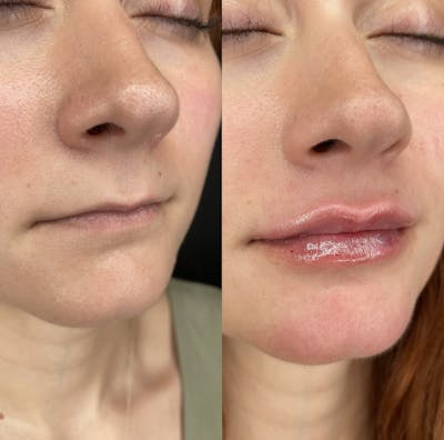 Lip Filler Before & After Gallery - Patient 179922 - Image 1