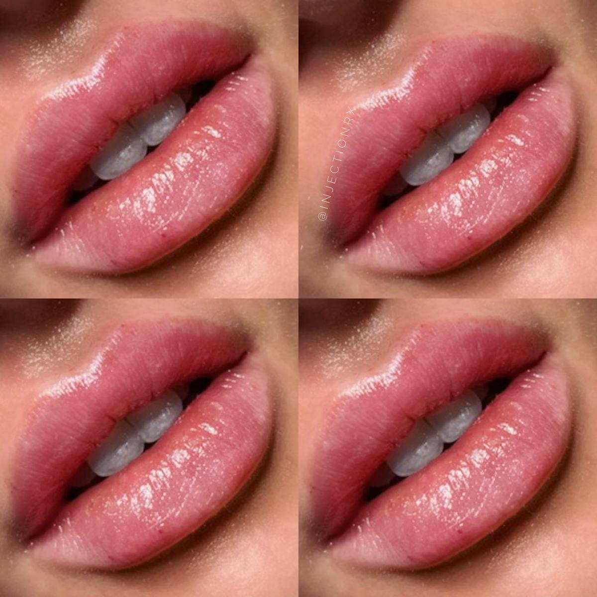 Lip Filler Before & After Gallery - Patient 230973 - Image 1