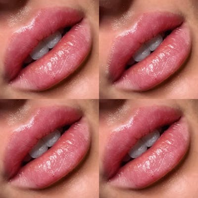 Lip Filler Before & After Gallery - Patient 230973 - Image 1