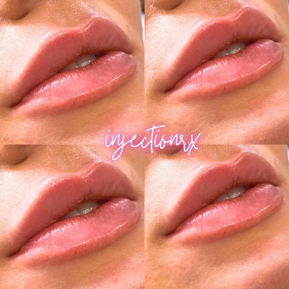 Lip Filler Before & After Gallery - Patient 171475 - Image 1