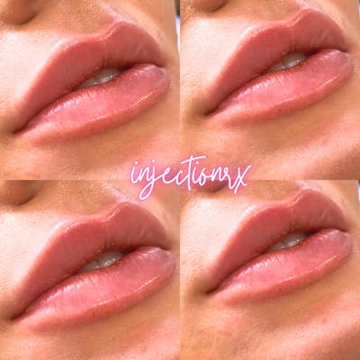 Lip Filler Before & After Gallery - Patient 171475 - Image 1