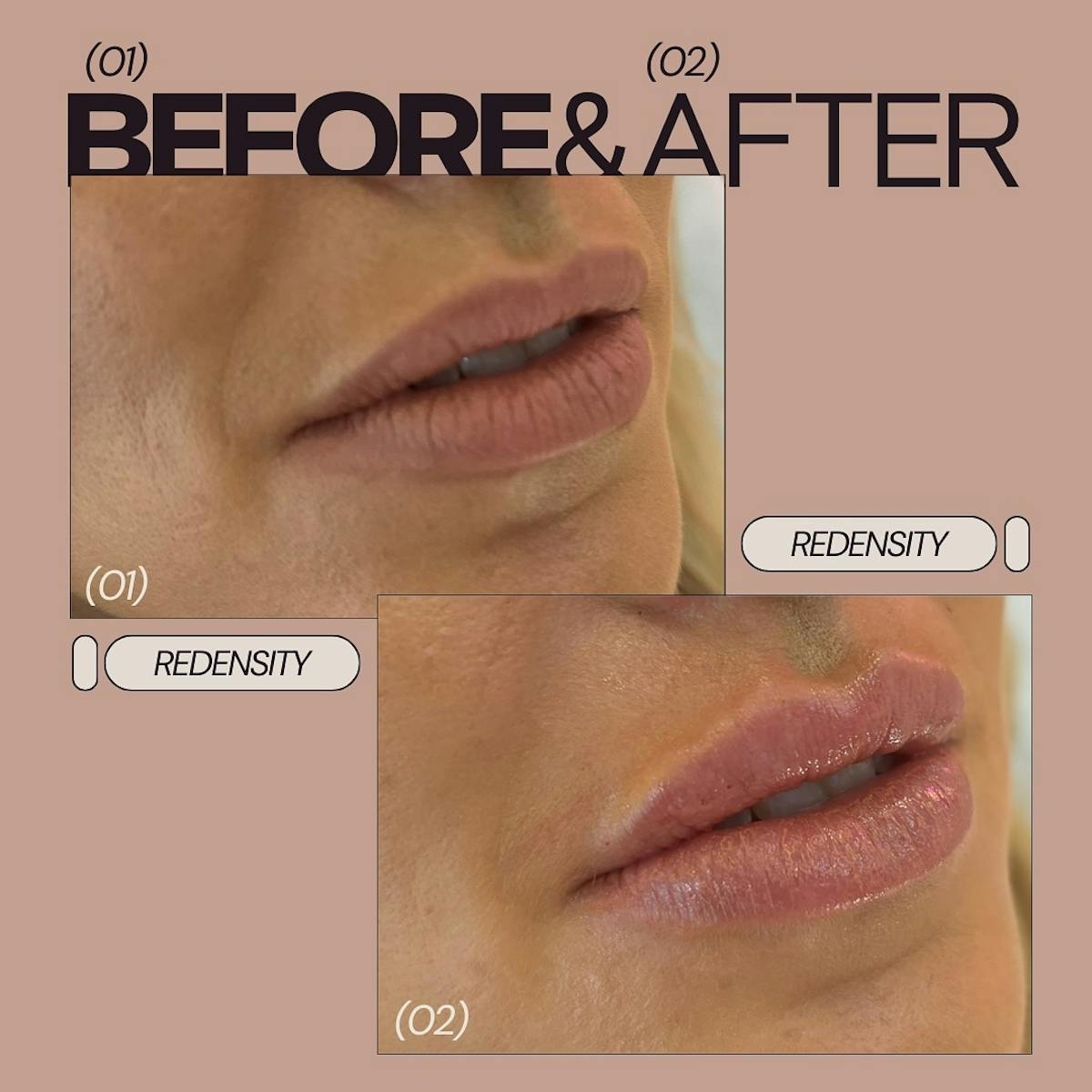 Lip Filler Before & After Gallery - Patient 340946 - Image 1