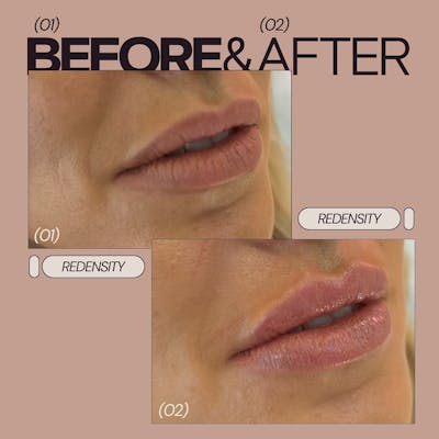 Lip Filler Before & After Gallery - Patient 340946 - Image 1