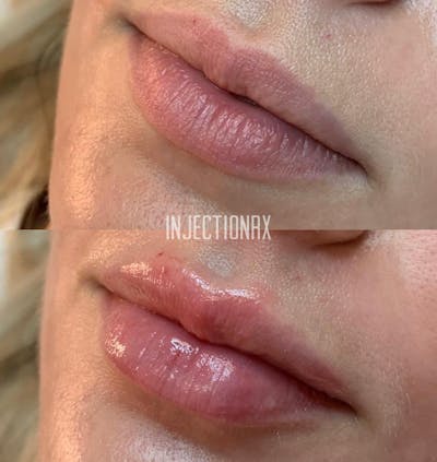 Lip Filler Before & After Gallery - Patient 384705 - Image 1