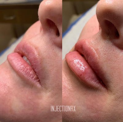 Lip Filler Before & After Gallery - Patient 121246 - Image 1
