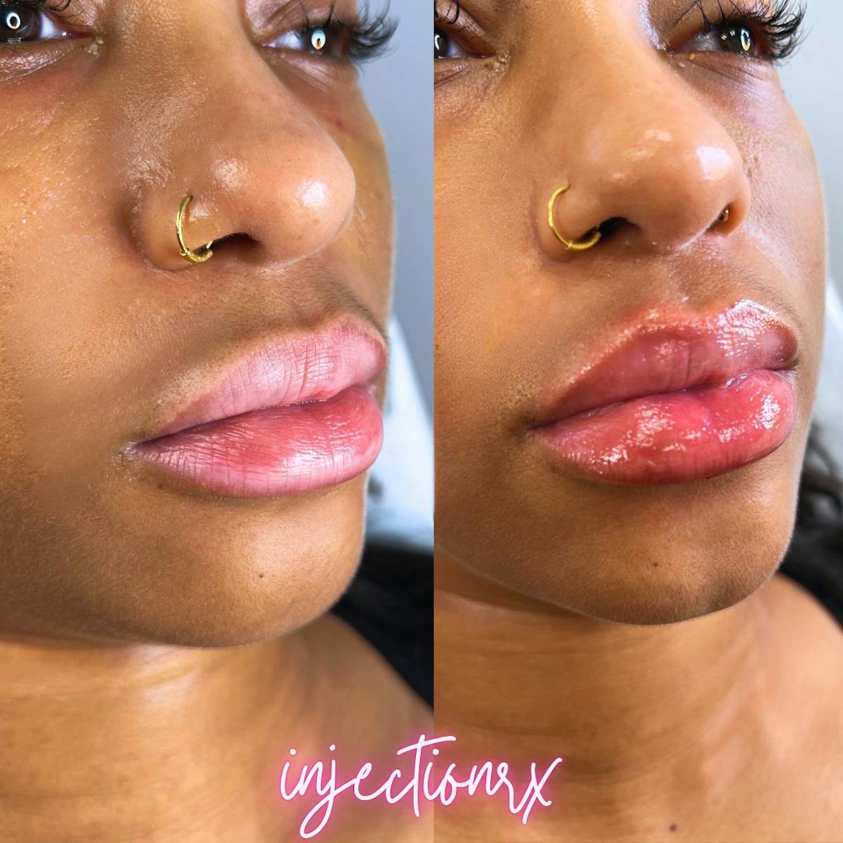 Lip Filler Before & After Gallery - Patient 146219 - Image 1