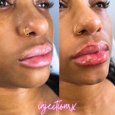 Lip Filler Before & After Gallery - Patient 146219 - Image 1