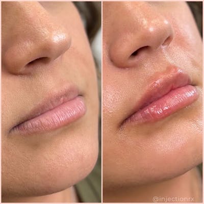 Lip Filler Before & After Gallery - Patient 311629 - Image 1
