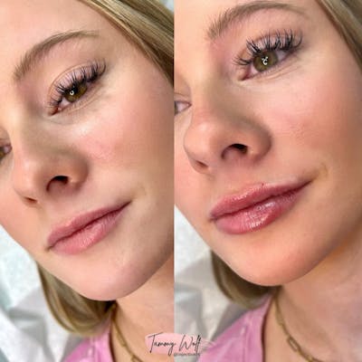 Lip Filler Before & After Gallery - Patient 412999 - Image 1