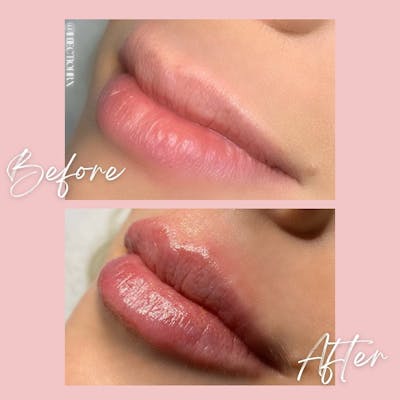 Lip Filler Before & After Gallery - Patient 625951 - Image 1