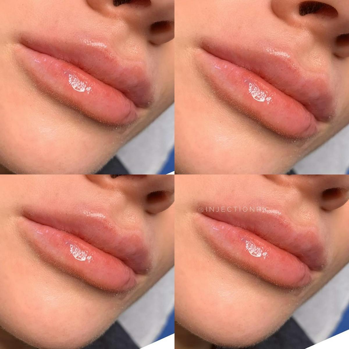 Lip Filler Before & After Gallery - Patient 237556 - Image 1
