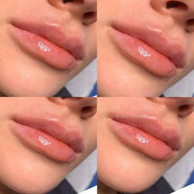 Lip Filler Before & After Gallery - Patient 237556 - Image 1
