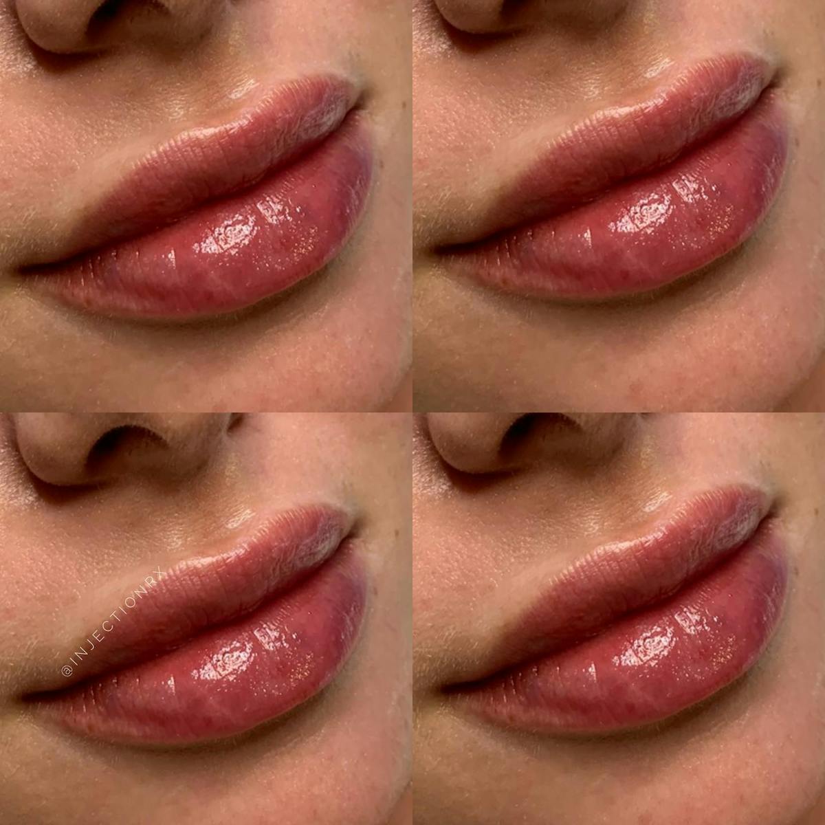 Lip Filler Before & After Gallery - Patient 194039 - Image 1