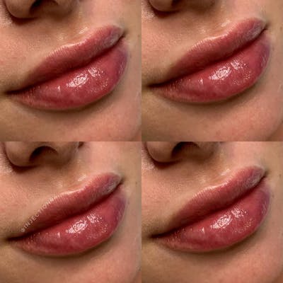 Lip Filler Before & After Gallery - Patient 194039 - Image 1