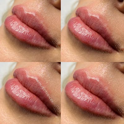 Lip Filler Before & After Gallery - Patient 243707 - Image 1