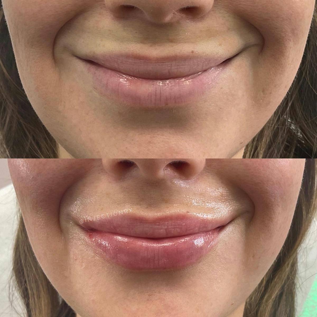 Lip Filler Before & After Gallery - Patient 394001 - Image 1