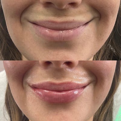 Lip Filler Before & After Gallery - Patient 394001 - Image 1