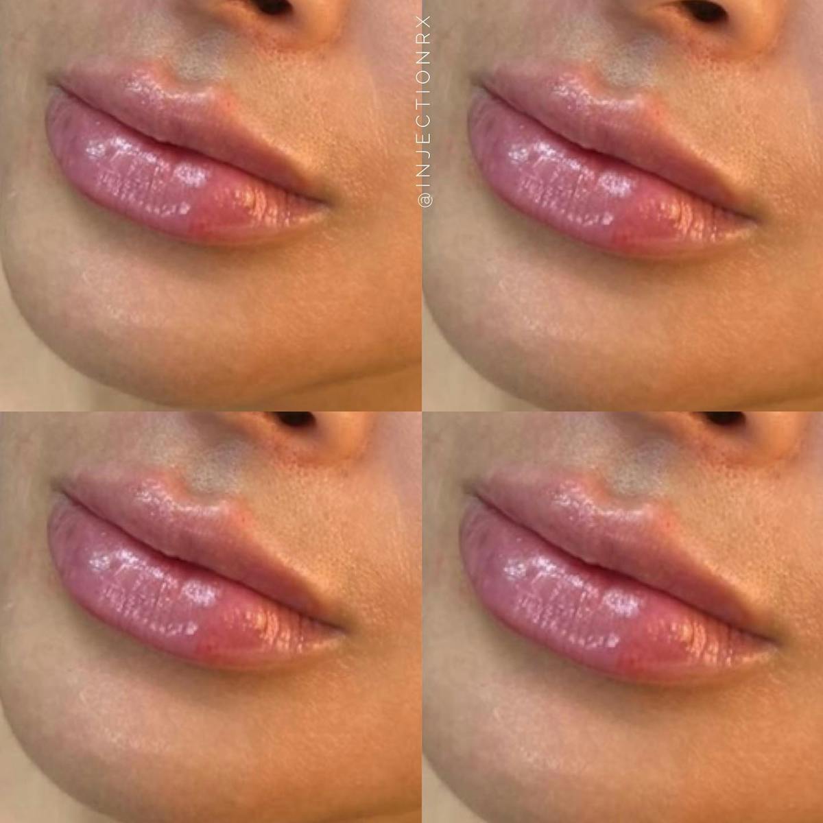 Lip Filler Before & After Gallery - Patient 316349 - Image 1