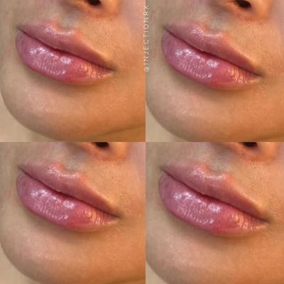 Lip Filler Before & After Gallery - Patient 316349 - Image 1