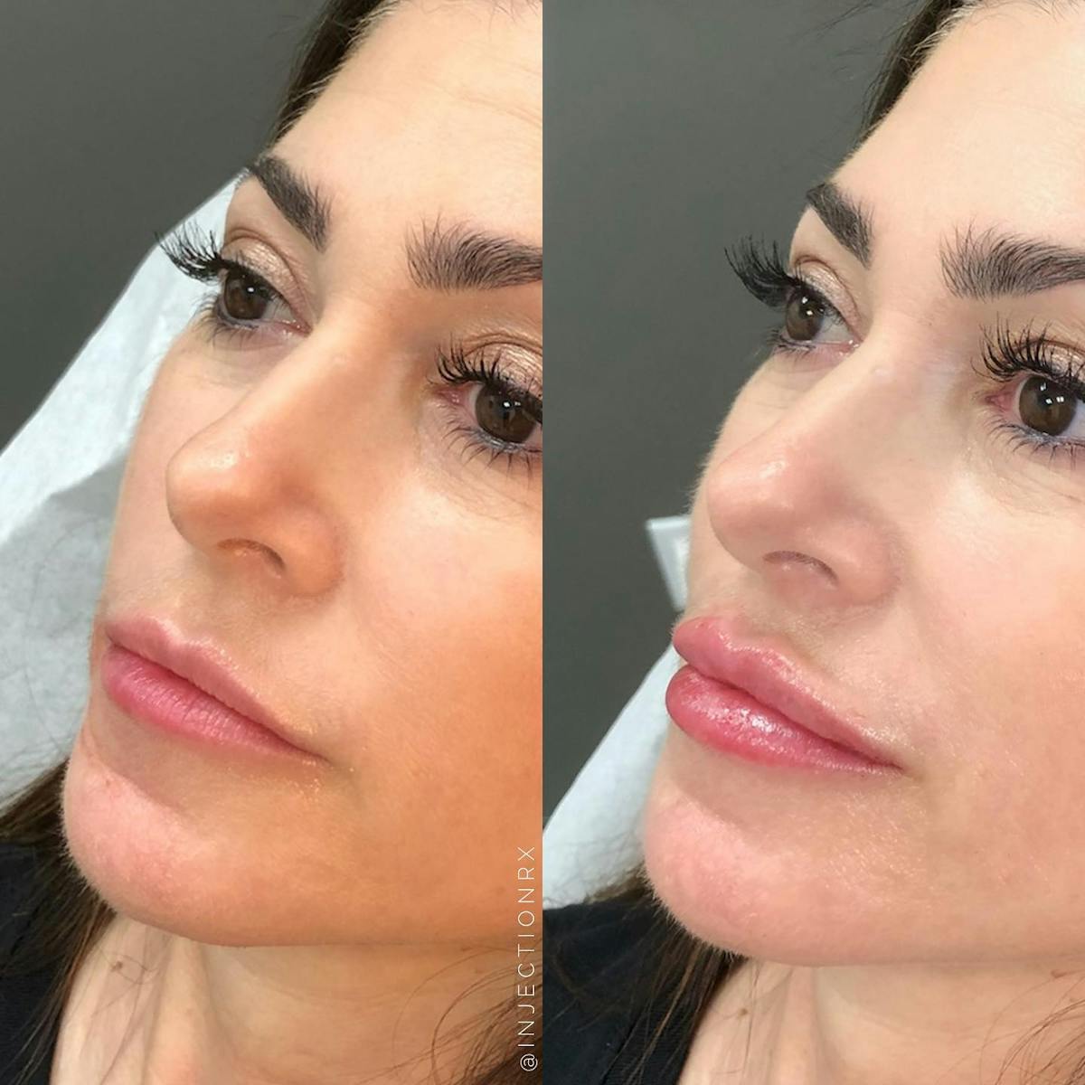 Lip Filler Before & After Gallery - Patient 406958 - Image 1