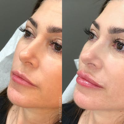 Lip Filler Before & After Gallery - Patient 406958 - Image 1