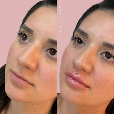 Lip Filler Before & After Gallery - Patient 917707 - Image 1