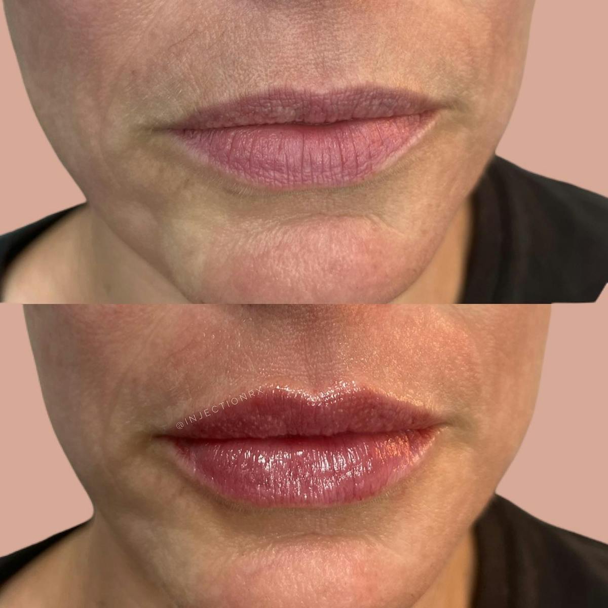 Lip Filler Before & After Gallery - Patient 181339 - Image 1