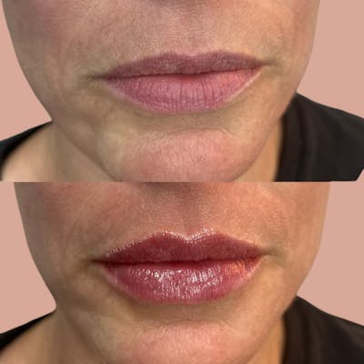 Lip Filler Before & After Gallery - Patient 181339 - Image 1