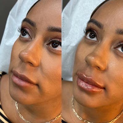 Lip Filler Before & After Gallery - Patient 512989 - Image 1