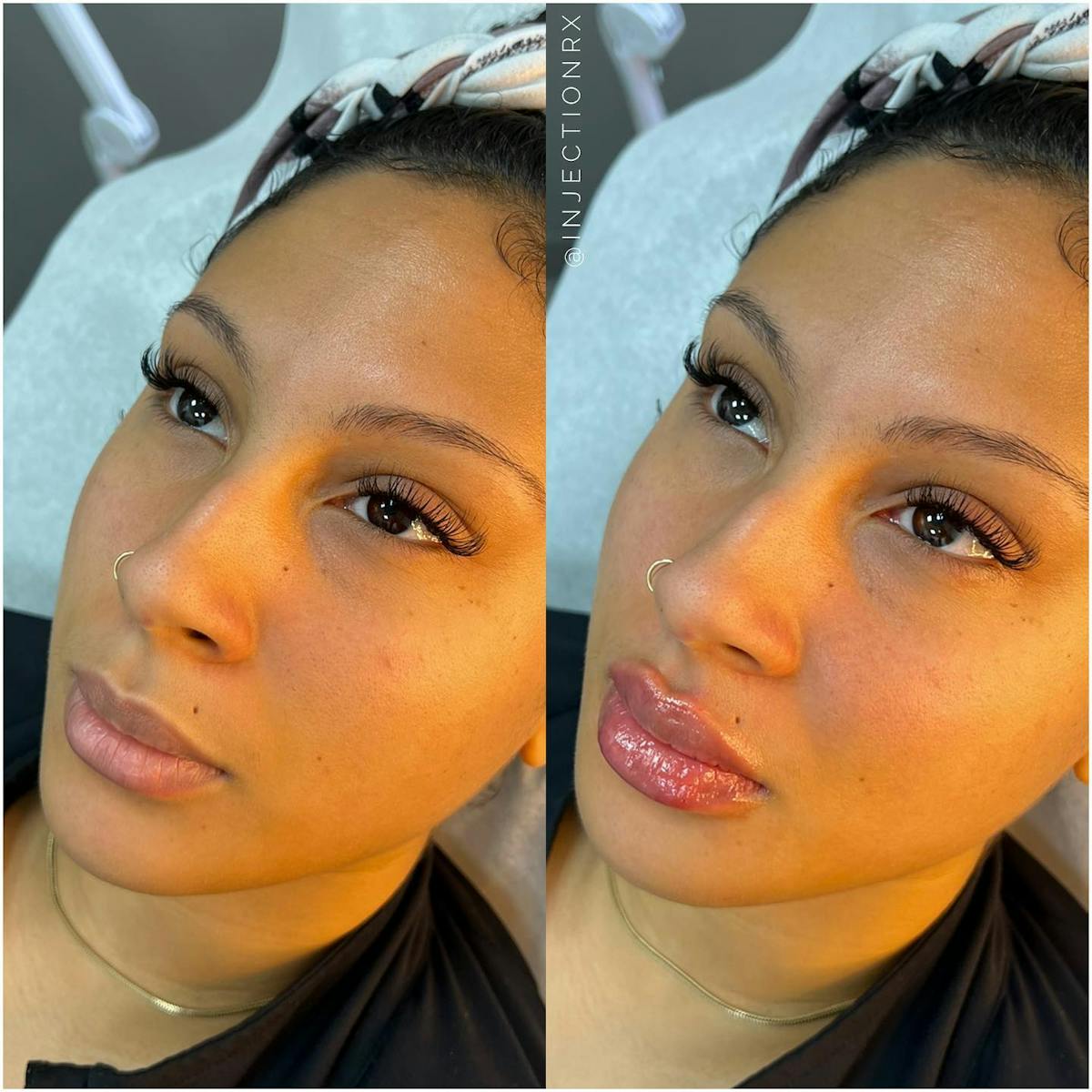 Lip Filler Before & After Gallery - Patient 333167 - Image 1