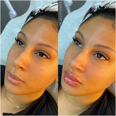 Lip Filler Before & After Gallery - Patient 333167 - Image 1
