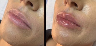 Lip Filler Before & After Gallery - Patient 259926 - Image 1