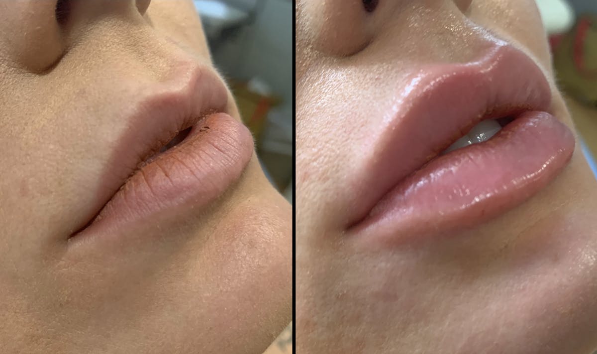 Lip Filler Before & After Gallery - Patient 239466 - Image 1