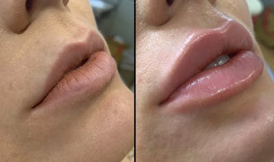 Lip Filler Before & After Gallery - Patient 239466 - Image 1