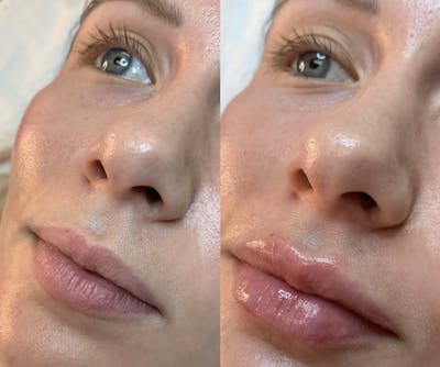Lip Filler Before & After Gallery - Patient 337521 - Image 1