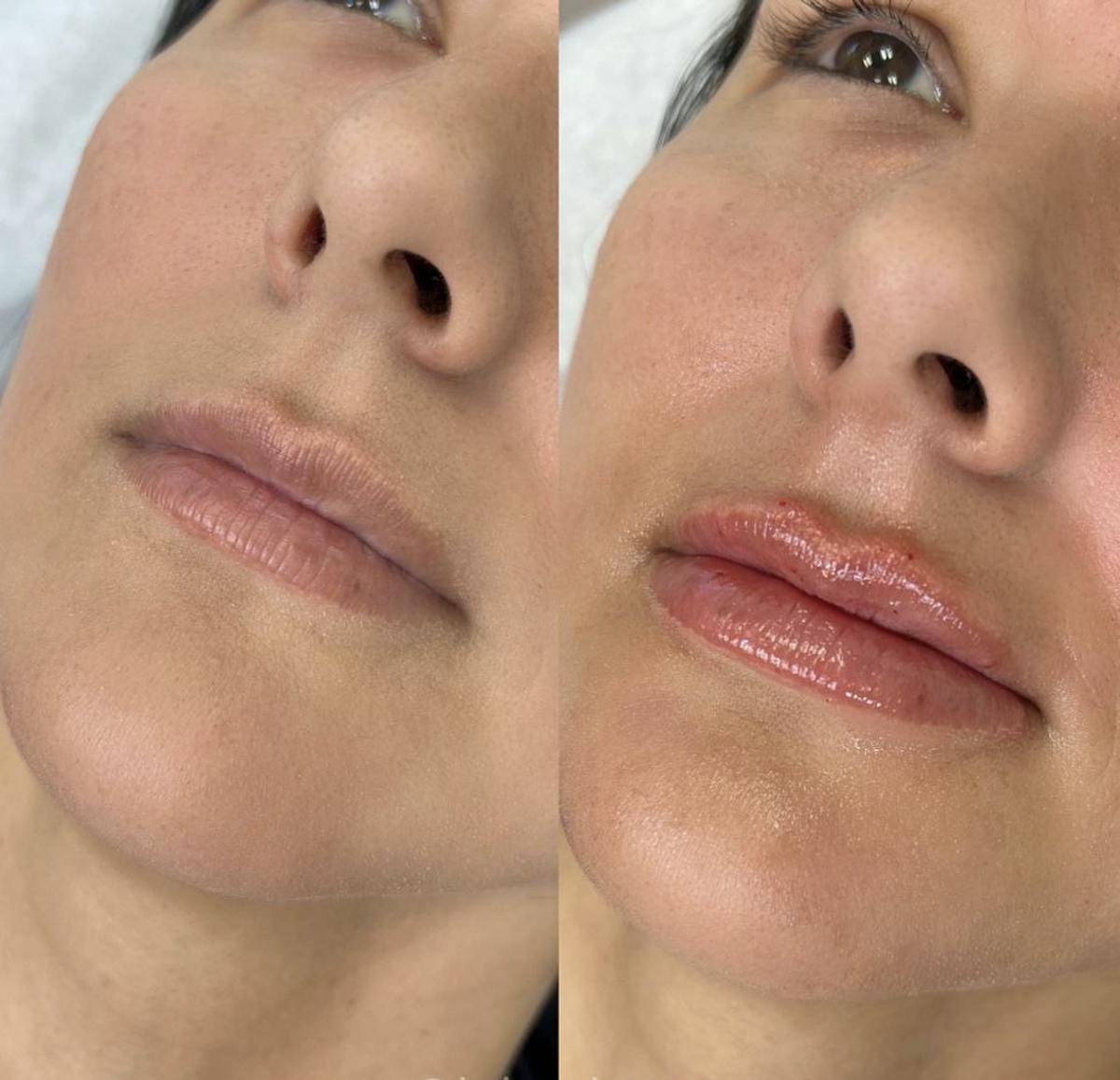 Lip Filler Before & After Gallery - Patient 331280 - Image 1