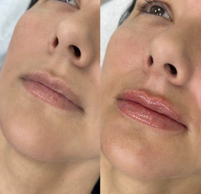 Lip Filler Before & After Gallery - Patient 331280 - Image 1