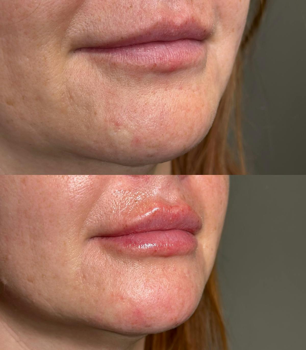 Lip Filler Before & After Gallery - Patient 216300 - Image 1