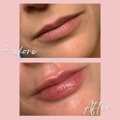 Lip Filler Before & After Gallery - Patient 927183 - Image 1