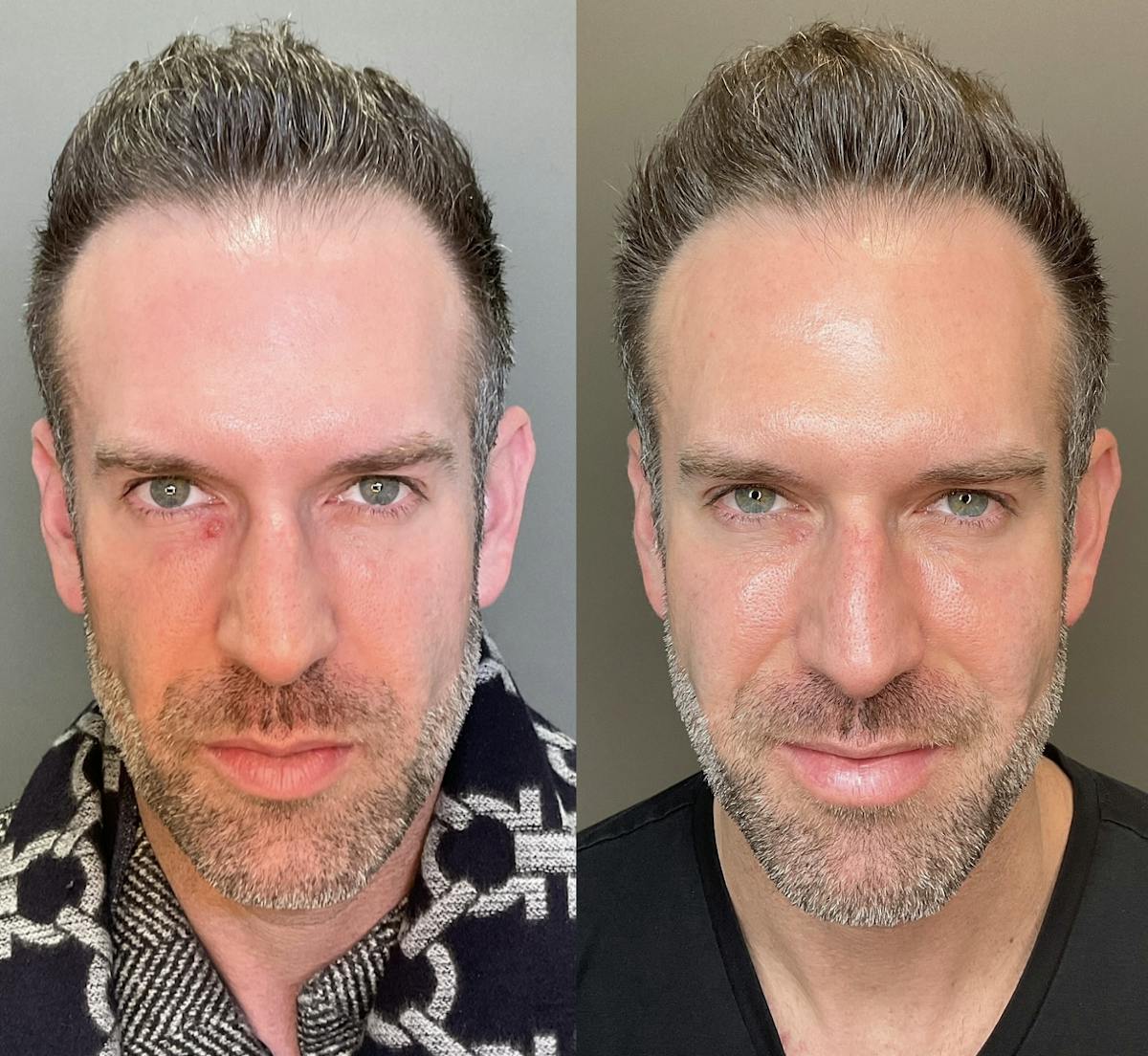 Cheek Filler Before & After Gallery - Patient 116819 - Image 1